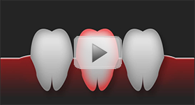 Tooth Replacement Townsville